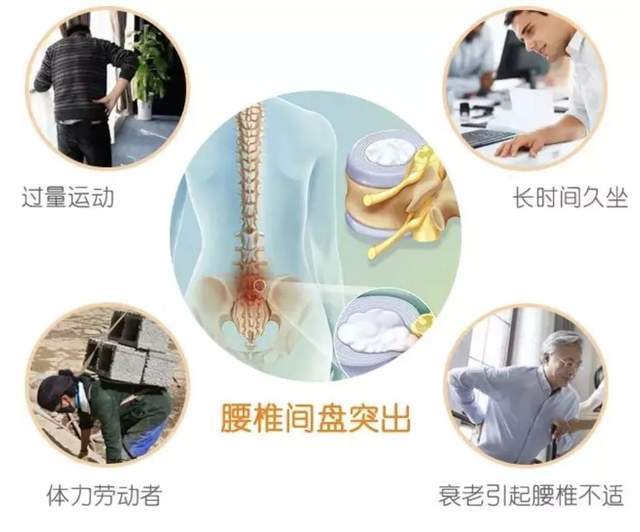 腰椎间盘突出又双叒叕发作了，这几个窍门能让你的腰腿痛不再复发